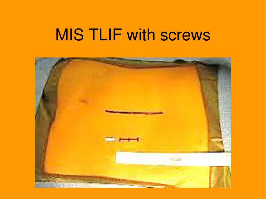 MIS TLIF with screws