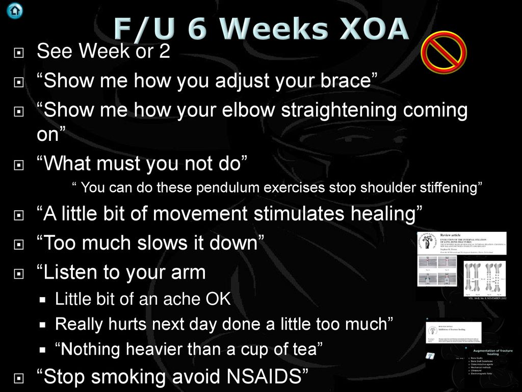 F/U 6 Weeks XOA See Week or 2 Show me how you adjust your brace