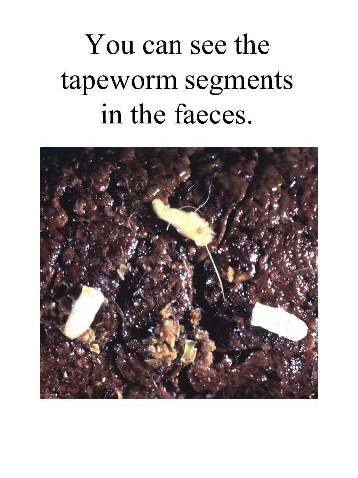 Tapeworm Segments In Human Stool