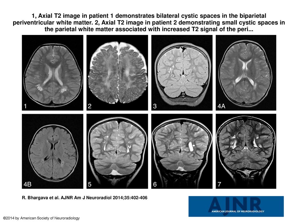 1, Axial T2 image in patient 1 demonstrates bilateral cystic spaces in ...