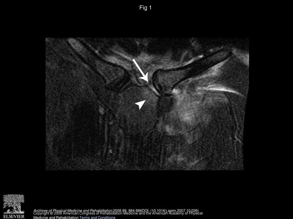 Septic Sternoclavicular Joint A Case Report Ppt Download