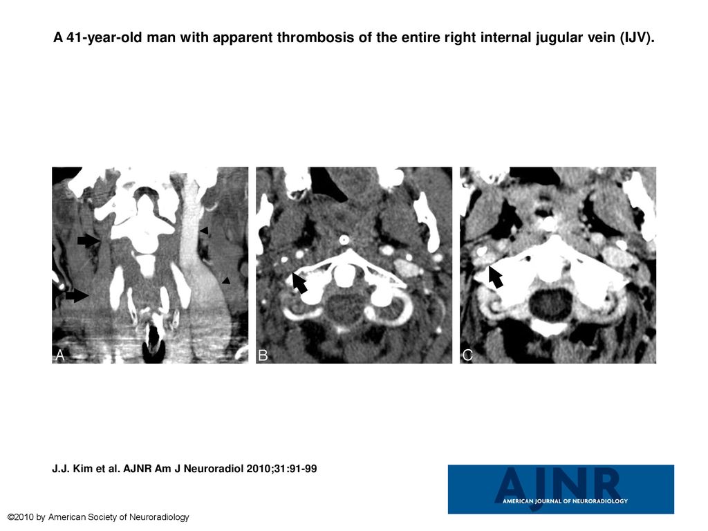 a-41-year-old-man-with-apparent-thrombosis-of-the-entire-right-internal