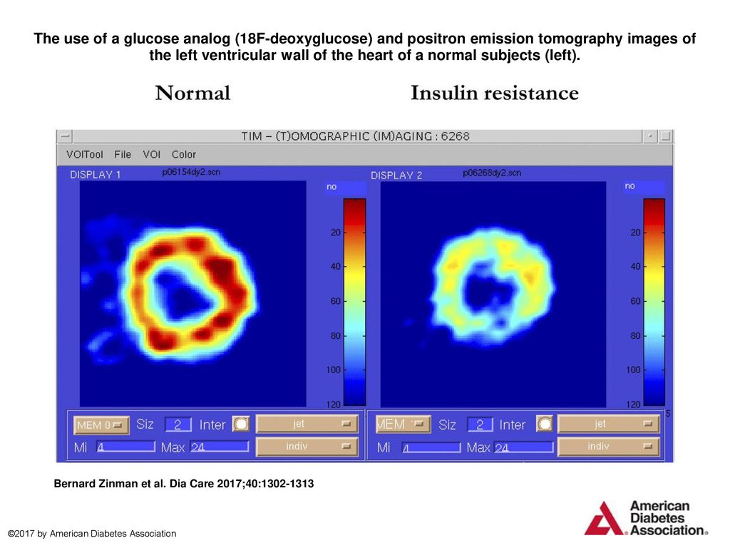 The use of a glucose analog (18F-deoxyglucose) and positron emission tomography images of the left ventricular wall of the heart of a normal subjects (left).