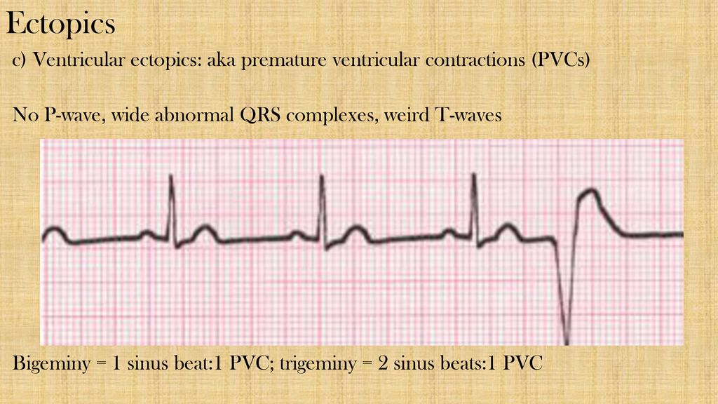 Lecture 5 Arrhythmias – part ppt download