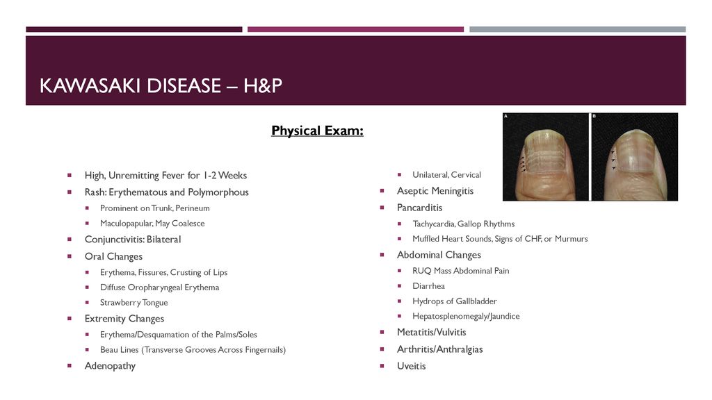 Kawasaki disease By: Brittni McClellan. - ppt download