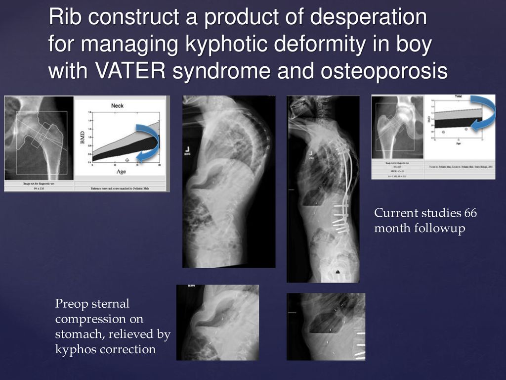 Kyphosis and Implantation Modeling a Clinical Phenomenom ppt download