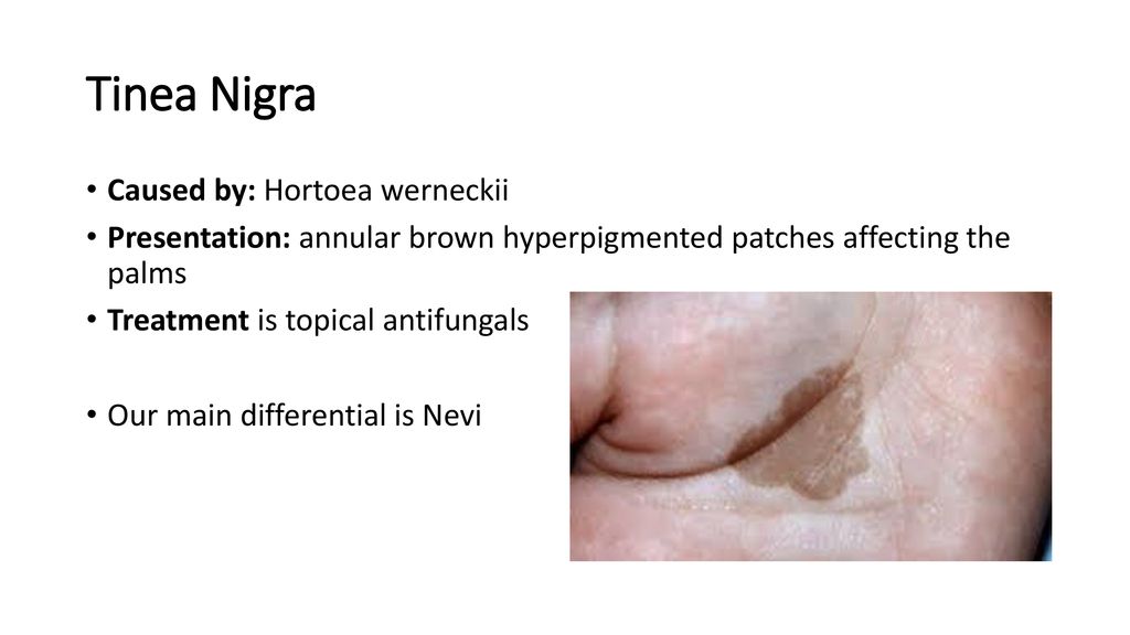 Fungal infections By: amin alajlouni. - ppt download