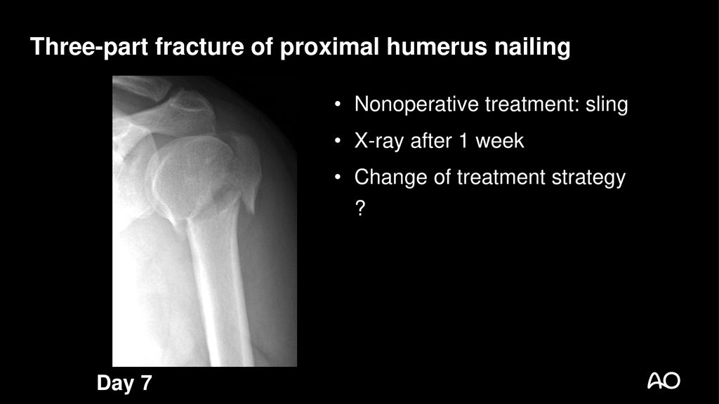 Distal locking technique affects the rate of iatrogenic radial nerve palsy  in intramedullary nailing of humeral shaft fractures | Archives of  Orthopaedic and Trauma Surgery