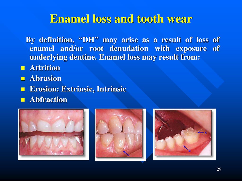 Dentine Hypersensitivity - Ppt Download