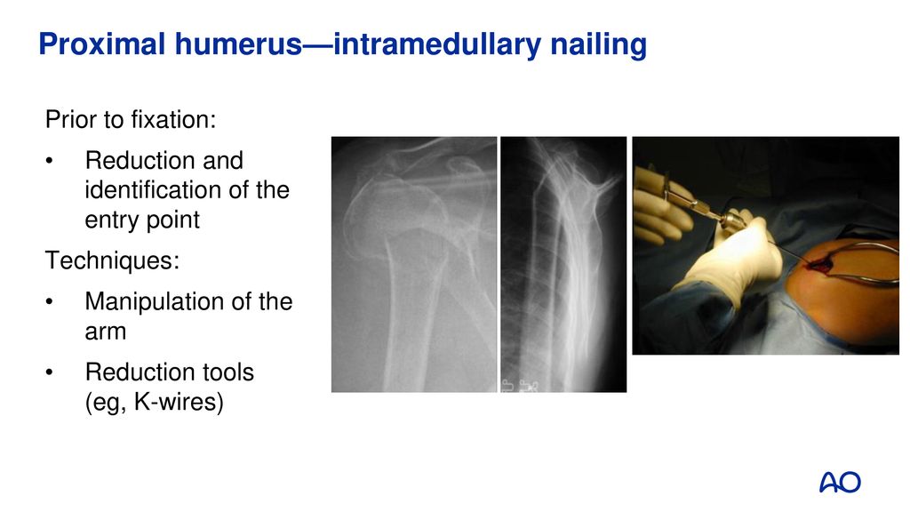 Lack of fifth anchoring point and violation of the insertion of the rotator  cuff during antegrade humeral nailing