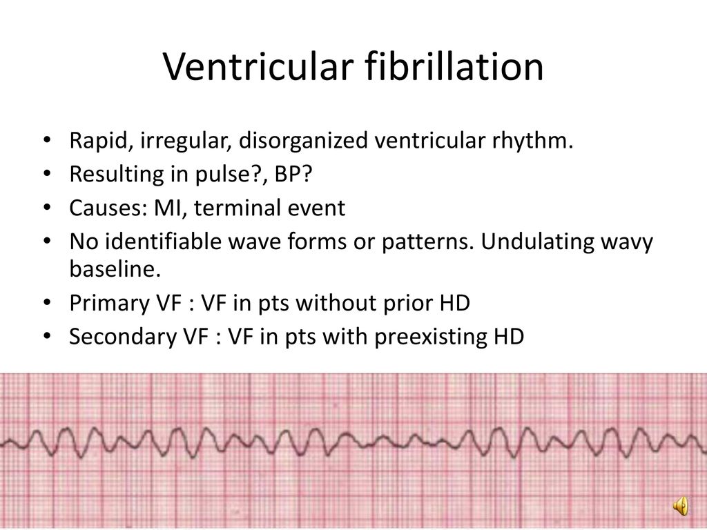 Ventricular Arrhythmias By Ecg Ppt Download Ventricular Arrhythmias By Ecg Ppt Download