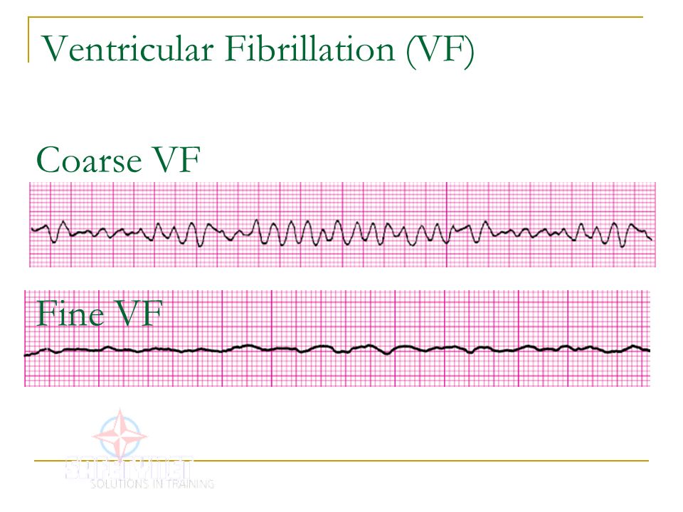 Ventricular Fibrillation (VF) .