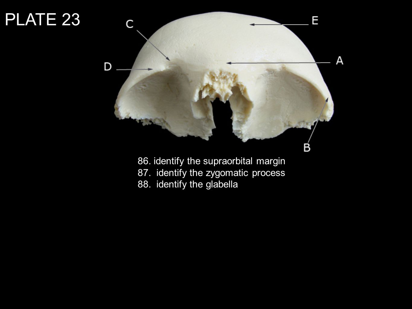 PLATE identify the supraorbital margin