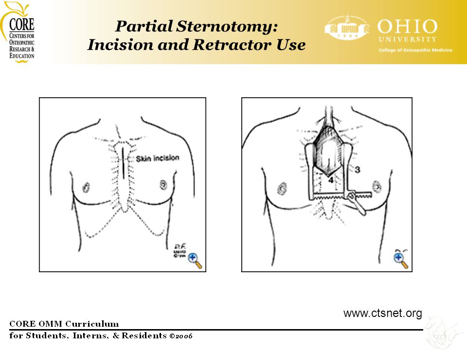 Median Sternotomy