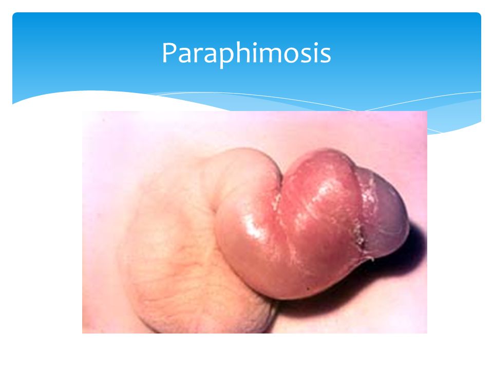 Paraphimosis.