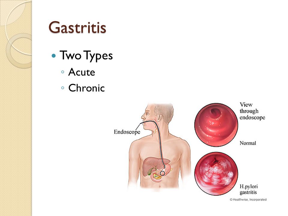 Gastritis Two Types Acute Chronic