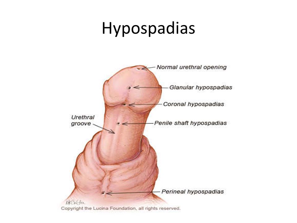 Hypospadiasis tünetei és kezelése