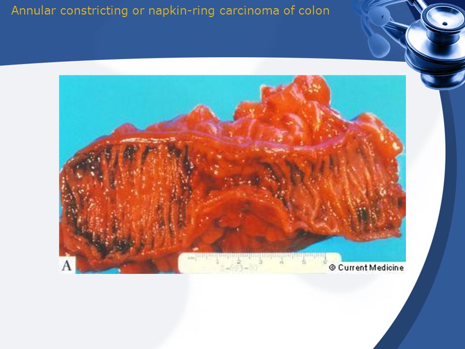 Image 2. Gross image of the colorectal tumor. Described as an “apple core”  or “napkin ring” lesion, which is granular in appearance, raised  (exophytic), or heaped edges with ulceration : Adenocarcinoma of