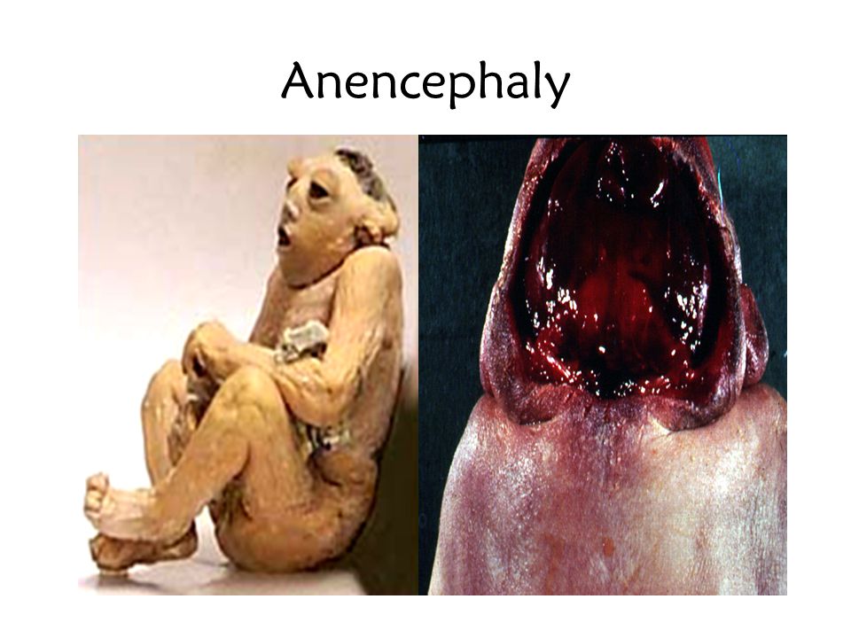 Anencephaly