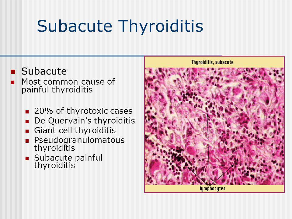 de quervain s thyroiditis symptoms nonbacterial prostatitis recovery time