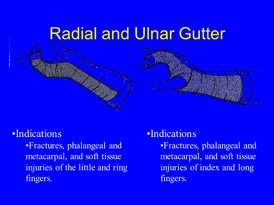 Splints And Casting Techniques Ppt Download