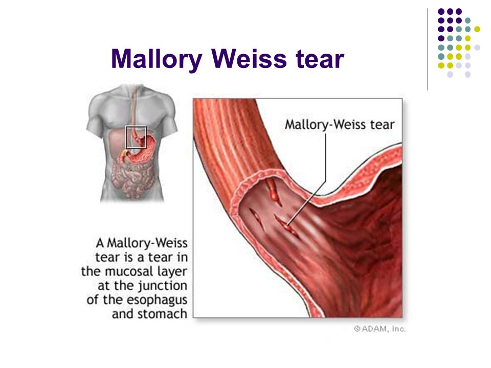 Кровь из пищевода. Синдром Маллори Вейсса. Синдром Маллори-Вейсса это что такое Мэллори Вейса. Синдром Мэллори Вейса эндоскопия. Синдром Мэллори Вейса степени.