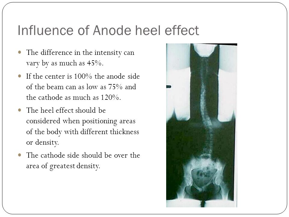 Heel Effect in X Ray Tube | Anode Heel Effect - YouTube
