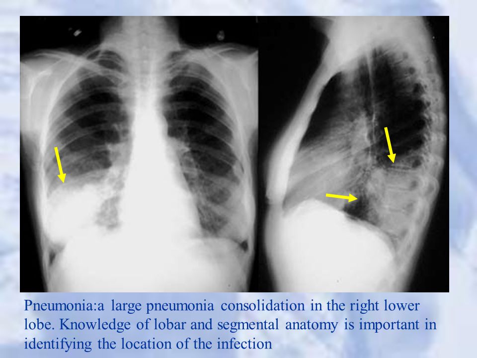 Chest X-ray Interpretation - ppt video online download