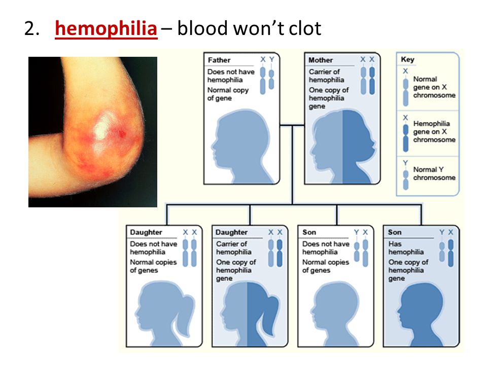 2. hemophilia – blood won’t clot