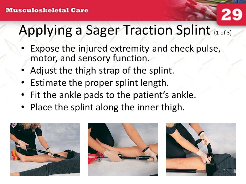 Applying a Hare Traction Splint (3 of 3) - ppt video online download