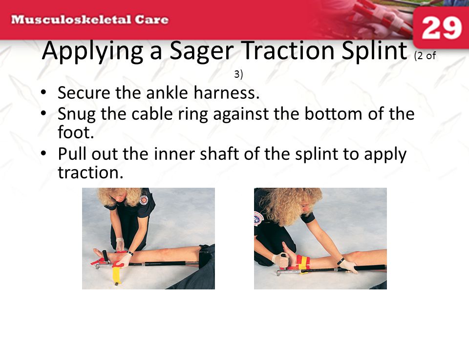 Applying a Hare Traction Splint (3 of 3) - ppt video online download