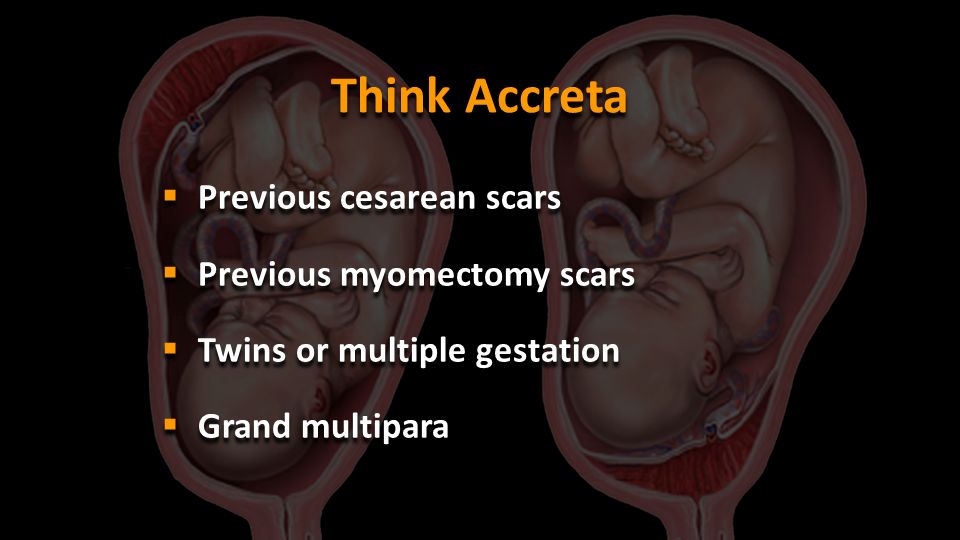 Think Accreta Previous cesarean scars Previous myomectomy scars