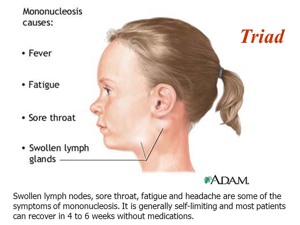 ...sore throat, fatigue and headache are some of the symptoms of mononucleo...