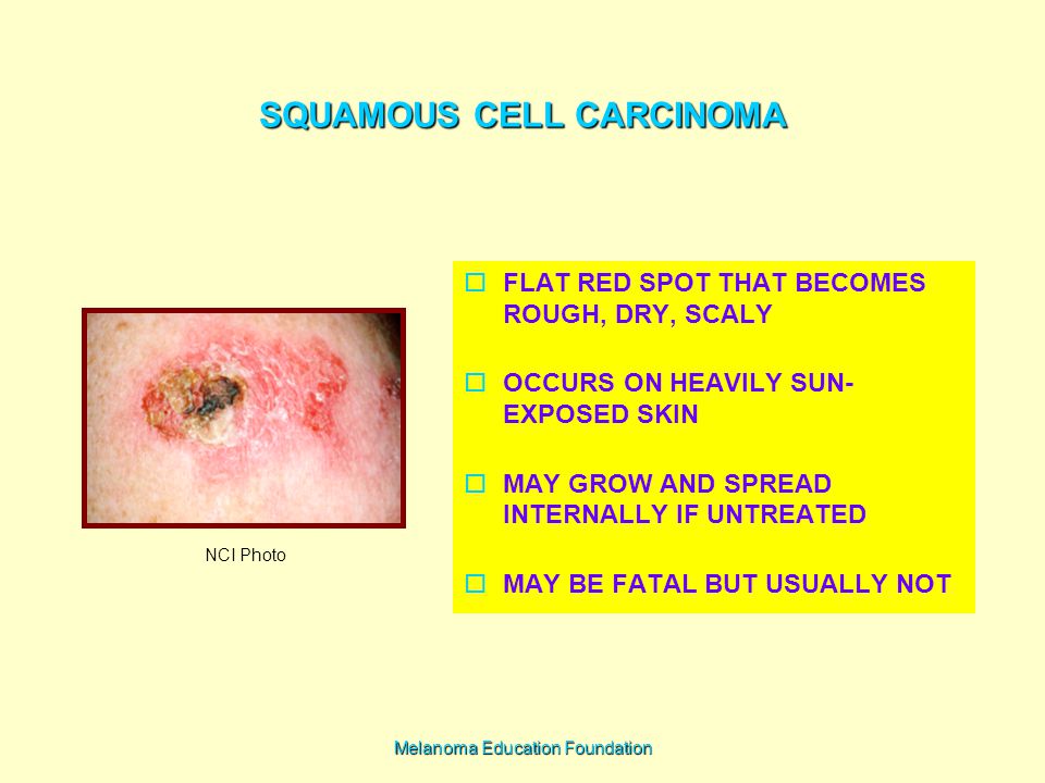 Melanoma Education Foundation Ppt Download