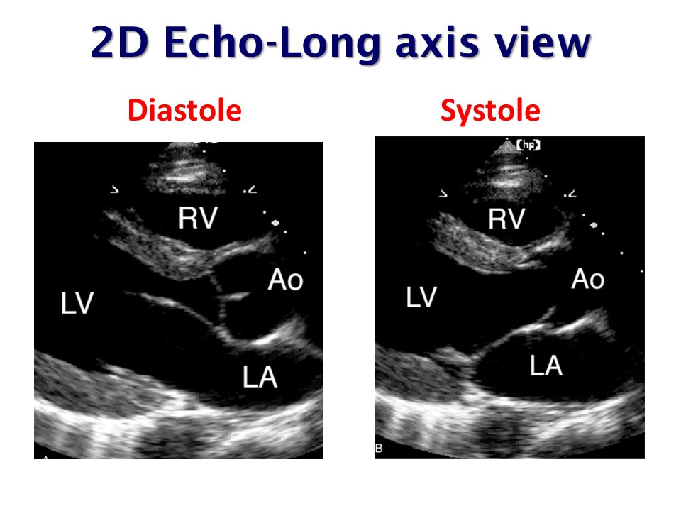 Где эхо. Aortic Stenosis Echocardiography. Aortic Stenosis Echocardiography Grafes. Long Echo. 