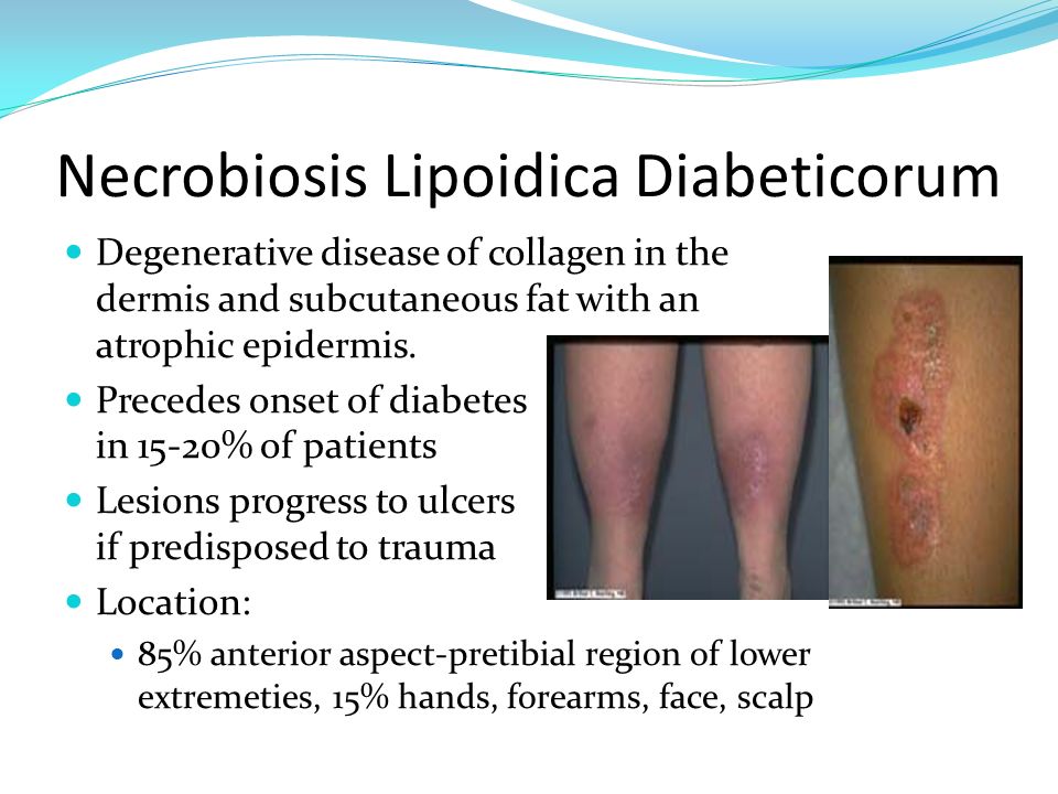 Lipoid necrobiosis cukorbetegeknél