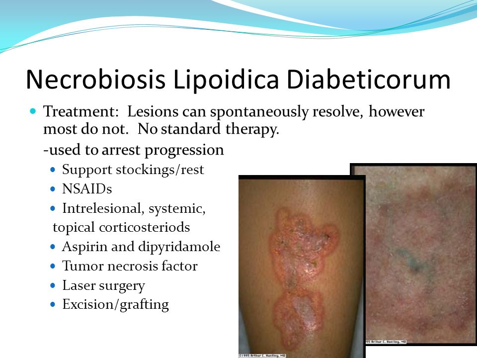 Lipoid necrobiosis cukorbetegeknél
