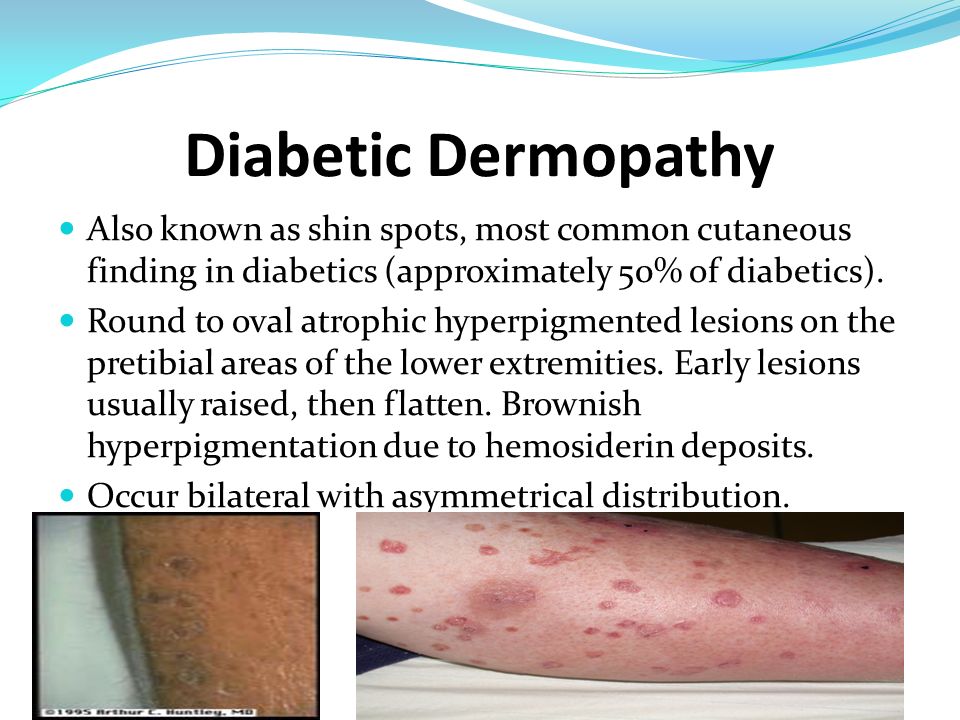 leg diabetic dermopathy diabetes research topic ideas