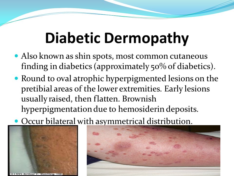 treatment for diabetic dermopathy