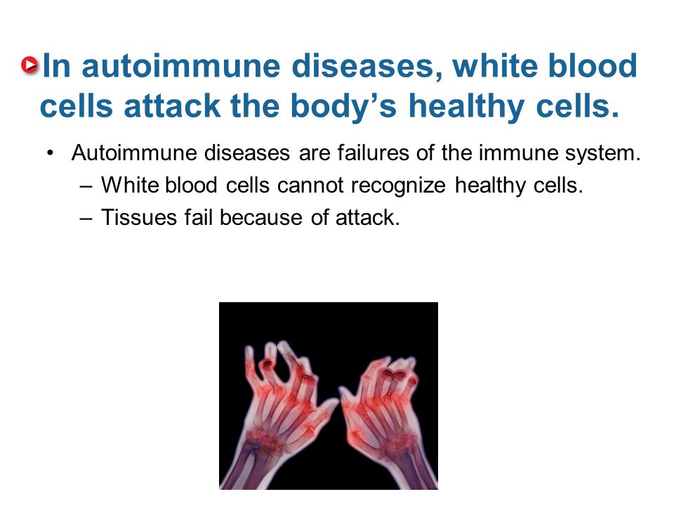 In autoimmune diseases, white blood cells attack the body’s healthy cells.