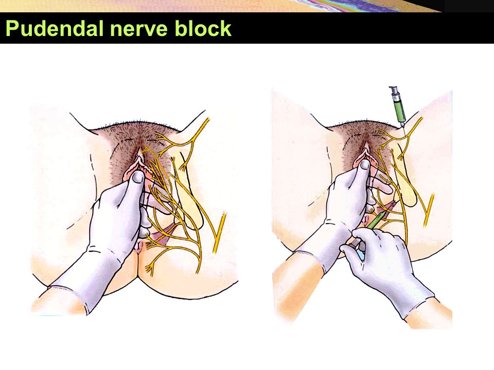 Pudendal nerve block