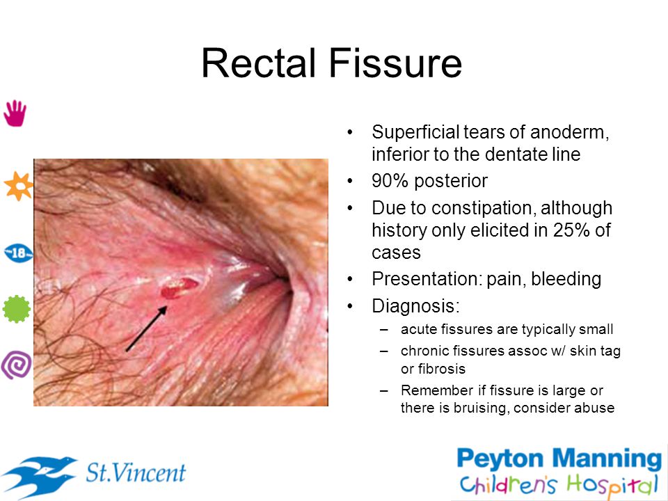 Characteristics Of Anal Fissureofficial Brand Site