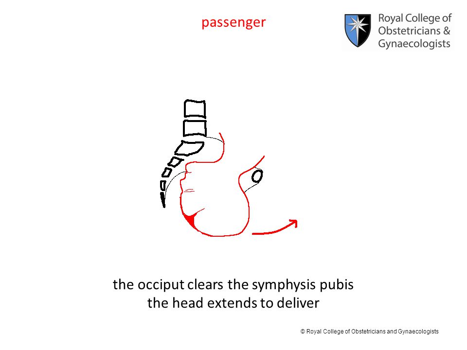 the occiput clears the symphysis pubis the head extends to deliver