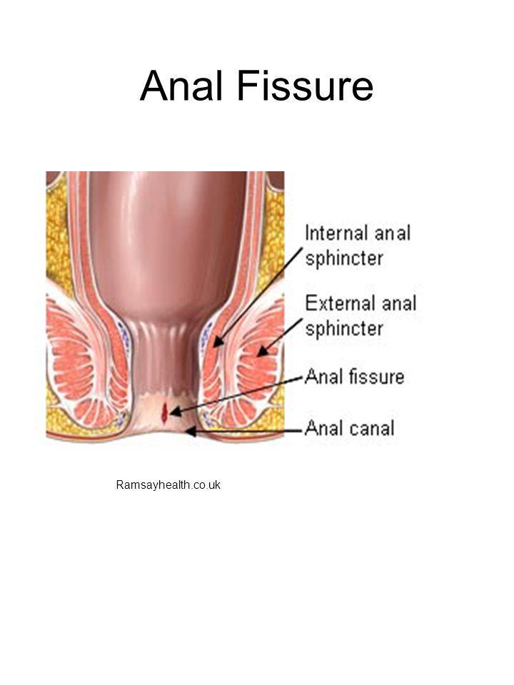 Home Remedies For Anal Fissure