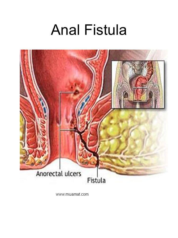 The Perirectal Fistula