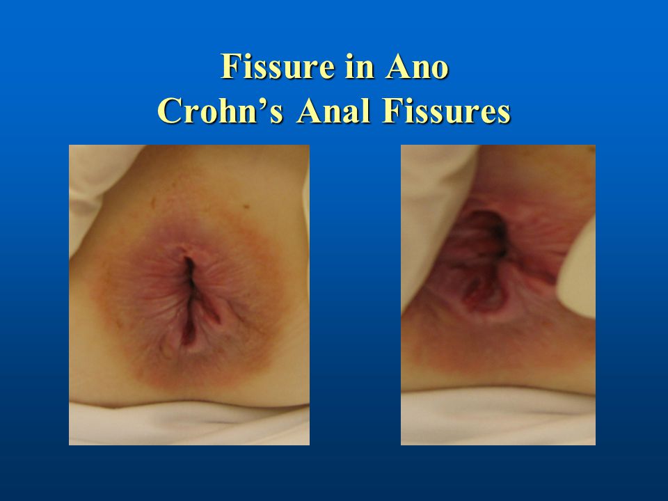 Anal fissure labor.