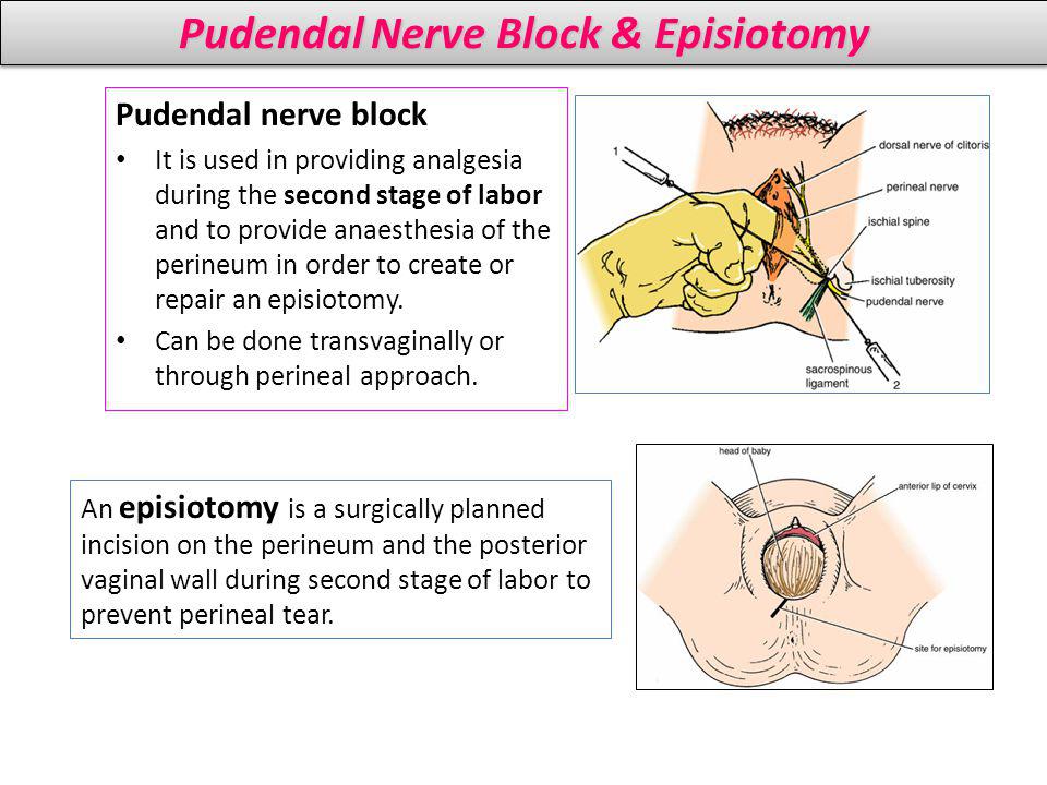 Pudendal Nerve Block & Episiotomy