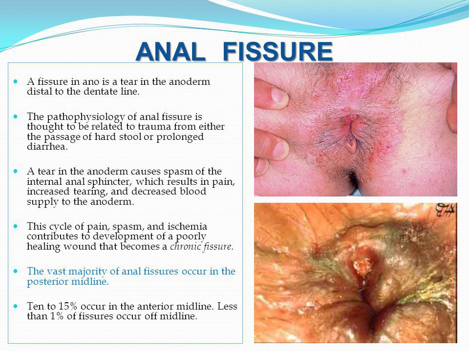Healing an anal fissure by sam summers
