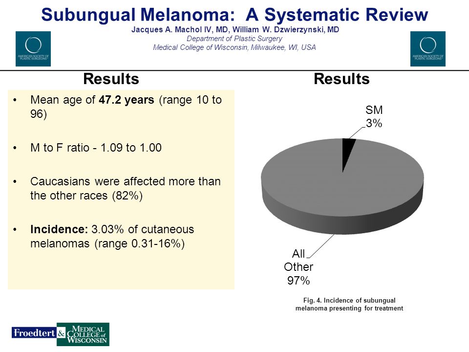 Fig. 4. Incidence of subungual melanoma presenting for treatment