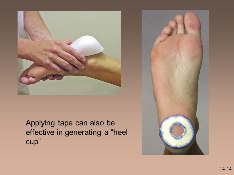 heel fat pad syndrome taping